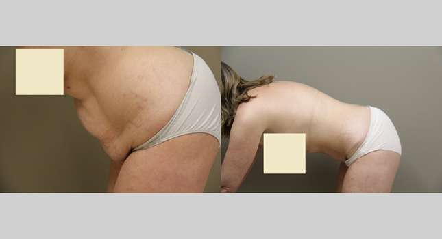 Tummy Tuck: Image #848