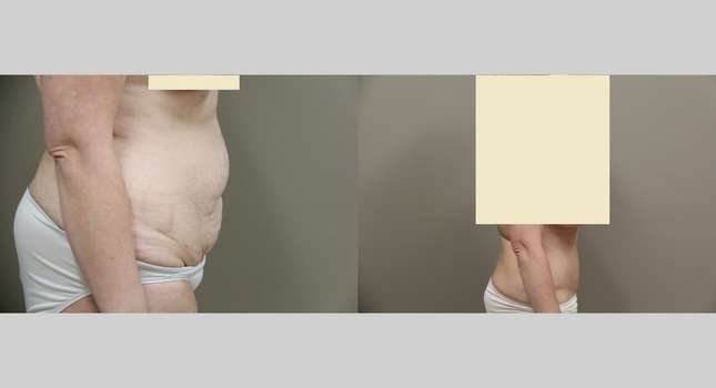Tummy Tuck: Image #849