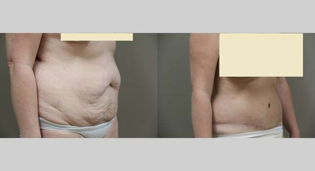 Tummy Tuck: Image #850