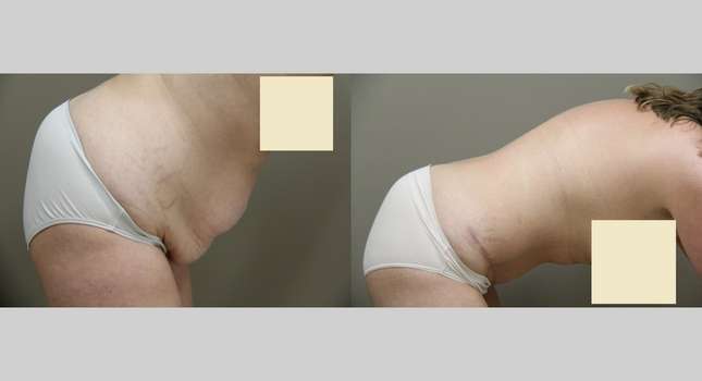 Tummy Tuck: Image #851