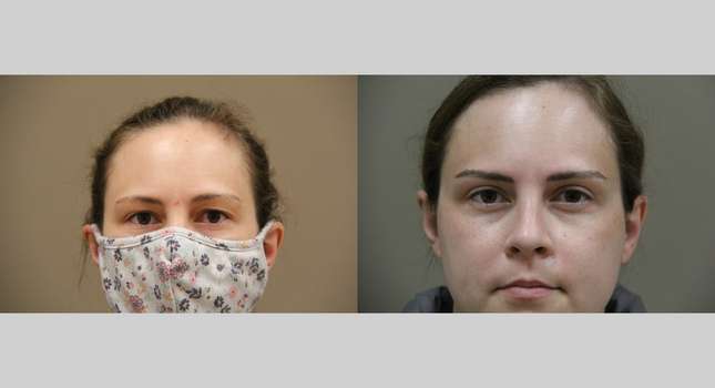 Eyelid Surgery: Image #857