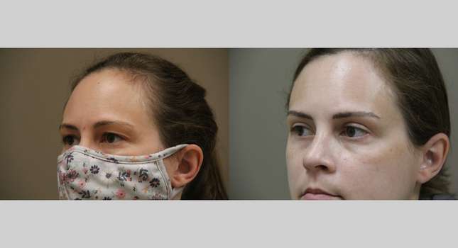 Eyelid Surgery: Image #858