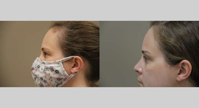 Eyelid Surgery: Image #859