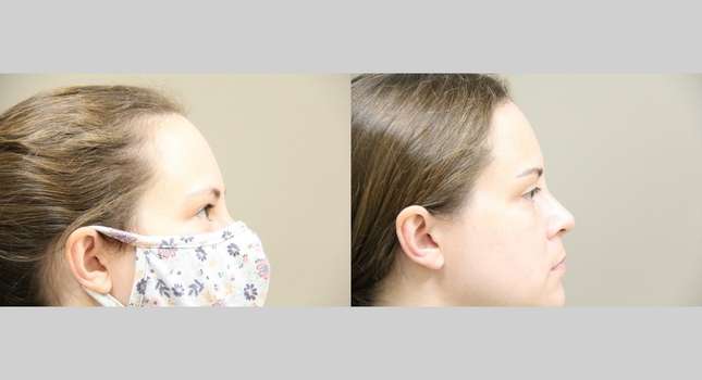 Eyelid Surgery: Image #860