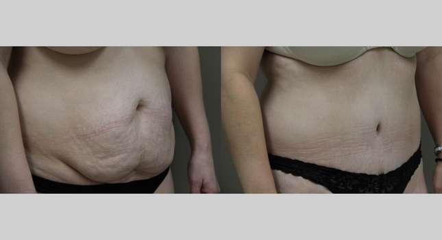 Tummy Tuck: Image #861