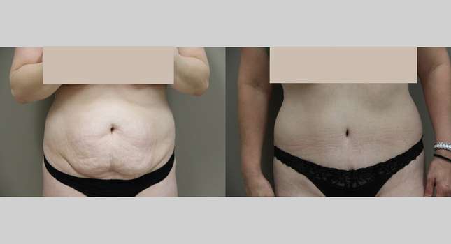 Tummy Tuck: Image #863