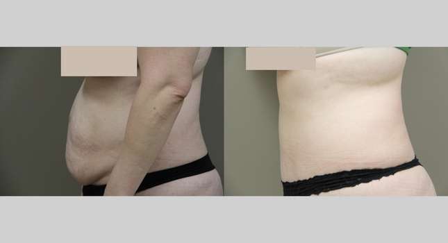 Tummy Tuck: Image #864