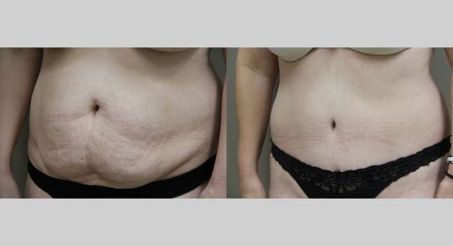 Tummy Tuck: Image #865