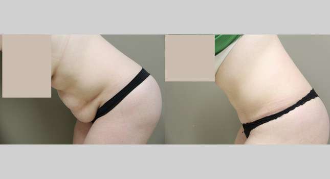 Tummy Tuck: Image #866