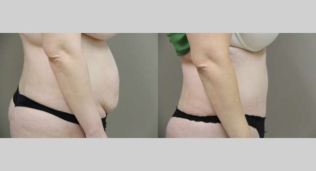 Tummy Tuck: Image #867