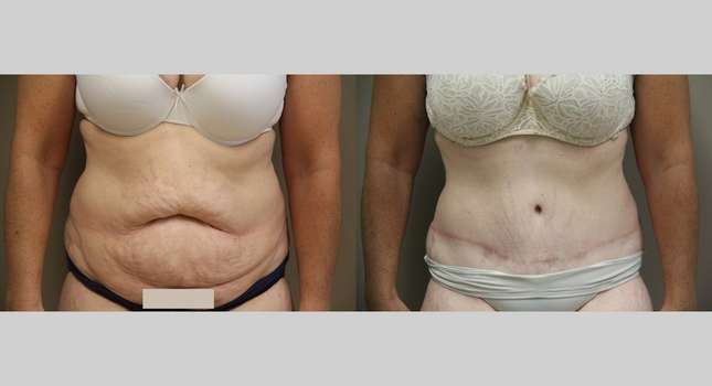 Tummy Tuck: Image #868