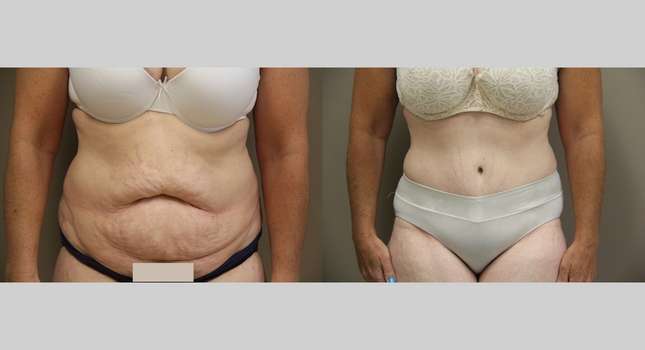 Tummy Tuck: Image #869