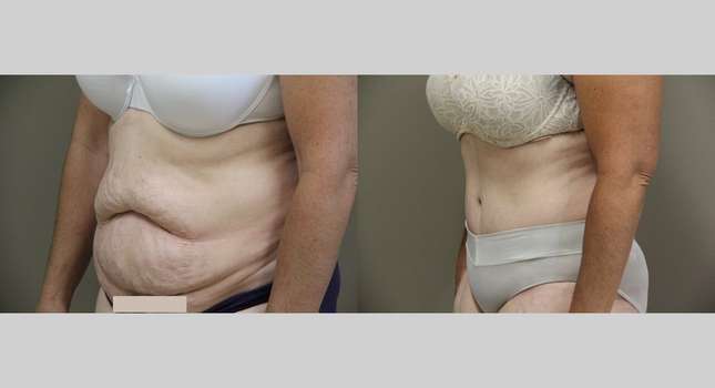 Tummy Tuck: Image #870