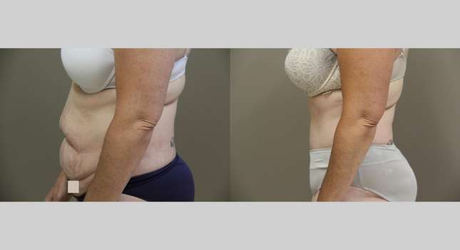 Tummy Tuck: Image #871