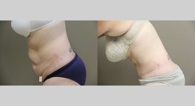 Tummy Tuck: Image #872