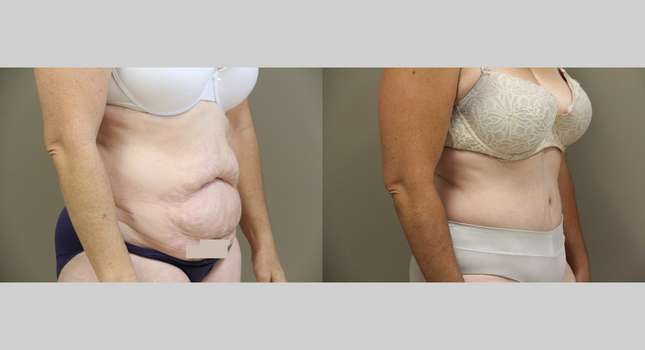 Tummy Tuck: Image #873