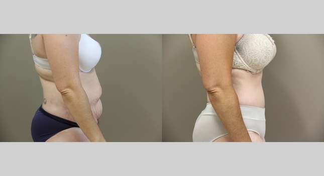 Tummy Tuck: Image #874