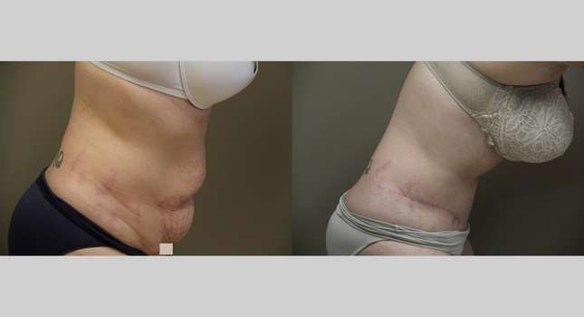 Tummy Tuck: Image #875