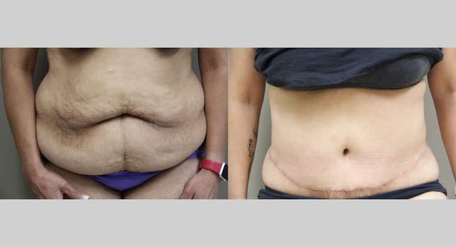 Body Lift: Image #876