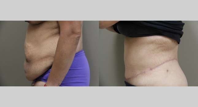 Body Lift: Image #877