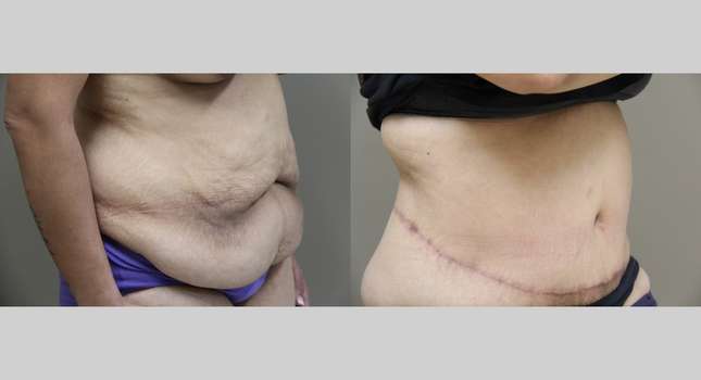 Body Lift: Image #880