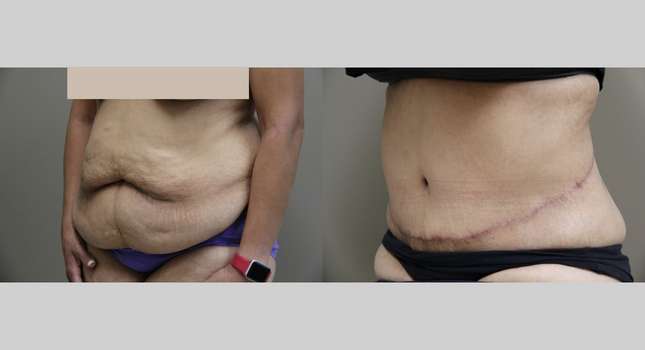 Body Lift: Image #881