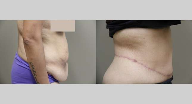 Body Lift: Image #882