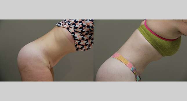 Body Lift: Image #883