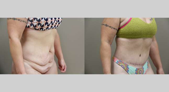 Body Lift: Image #884