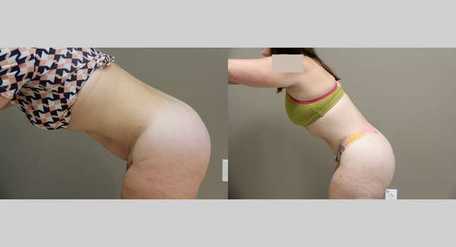 Body Lift: Image #886