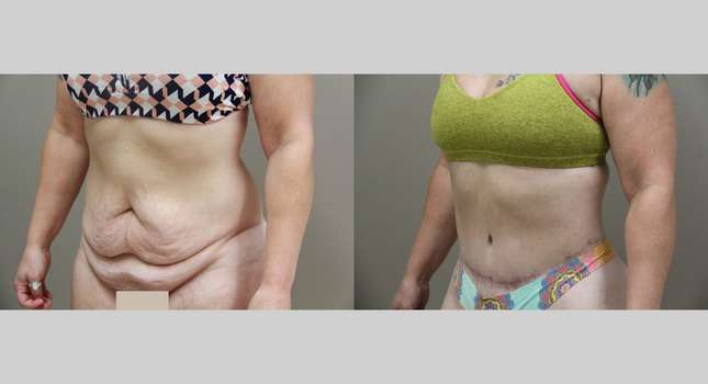 Body Lift: Image #887