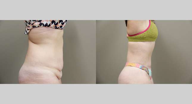 Body Lift: Image #891