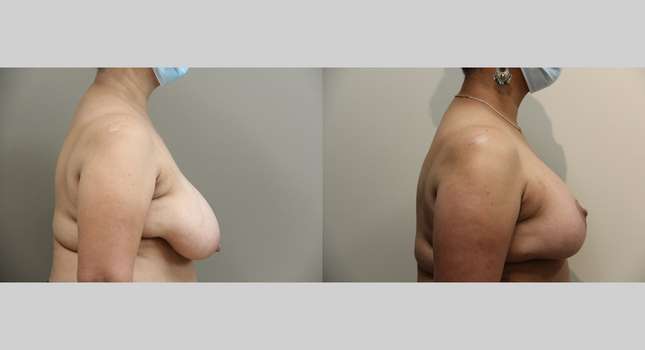 Breast Reconstruction: Image #893
