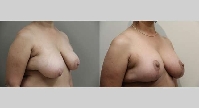 Breast Reconstruction: Image #894
