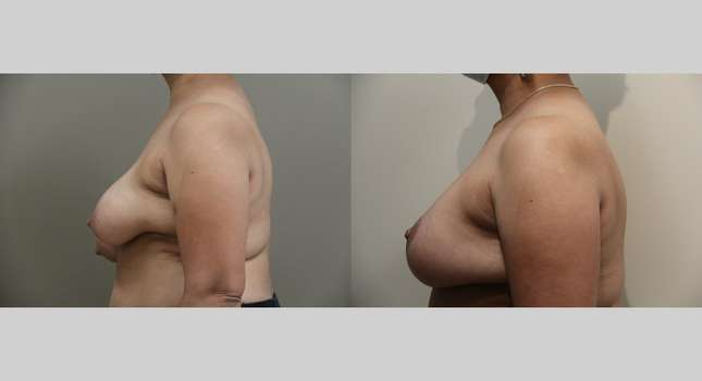 Breast Reconstruction: Image #895