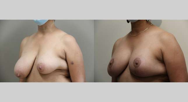 Breast Reconstruction: Image #896