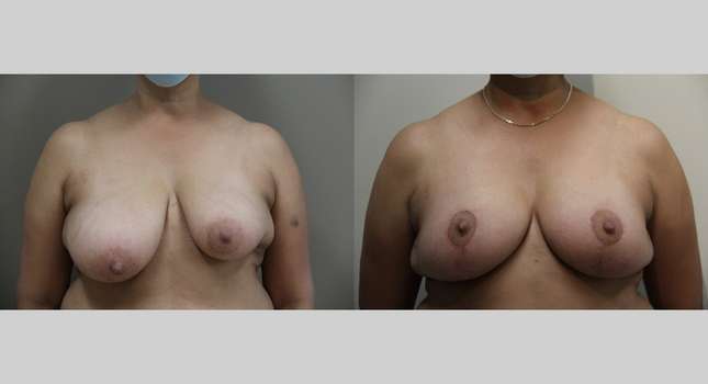 Breast Reconstruction: Image #897