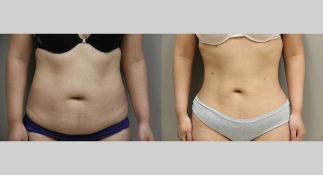 Liposuction: Image #908