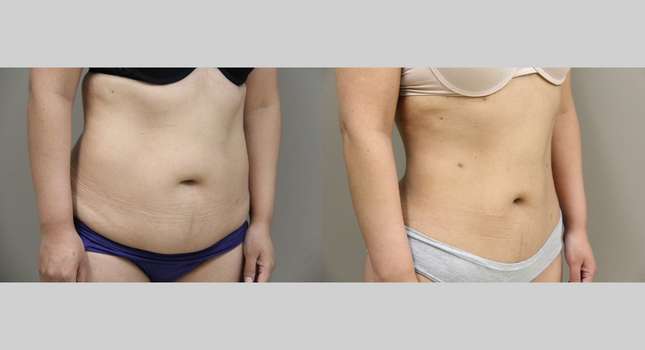 Liposuction: Image #909