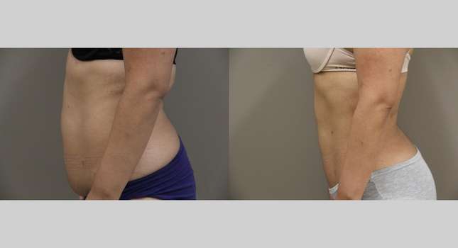 Liposuction: Image #910