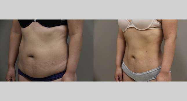 Liposuction: Image #911