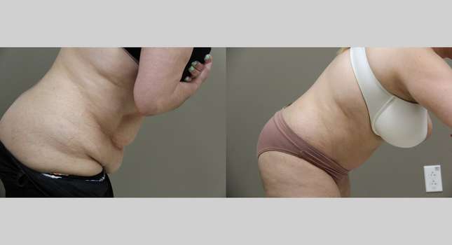Tummy Tuck: Image #917
