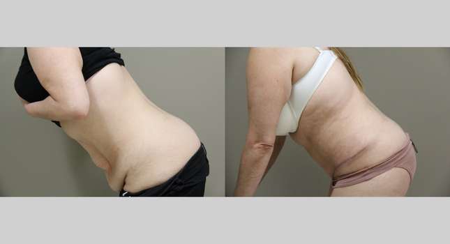 Tummy Tuck: Image #918