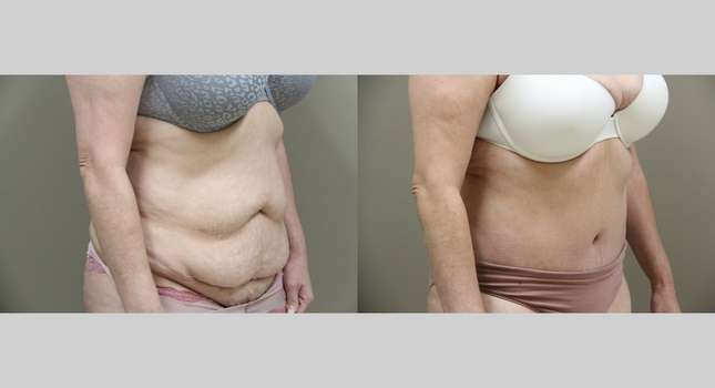 Tummy Tuck: Image #919