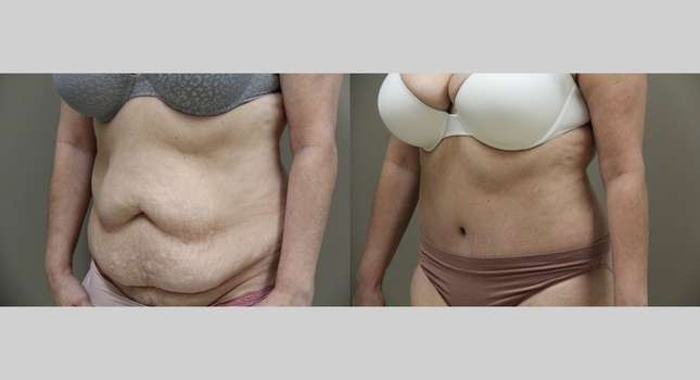 Tummy Tuck: Image #920