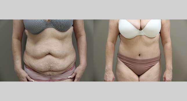 Tummy Tuck: Image #921