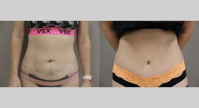 Tummy Tuck: Image #922