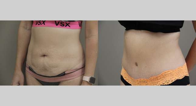 Tummy Tuck: Image #923