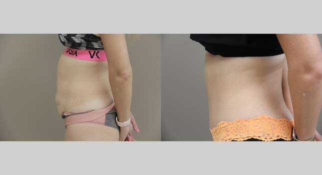 Tummy Tuck: Image #924