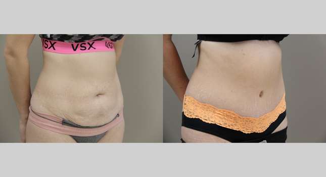 Tummy Tuck: Image #925